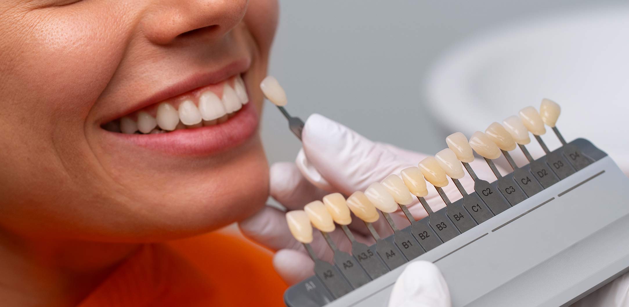 Carillas dentales, estética dental en Fuenlabrada